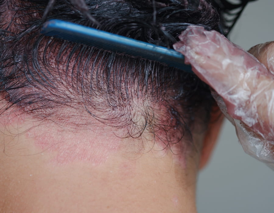 Allergies peau et cheveux produits chimiques